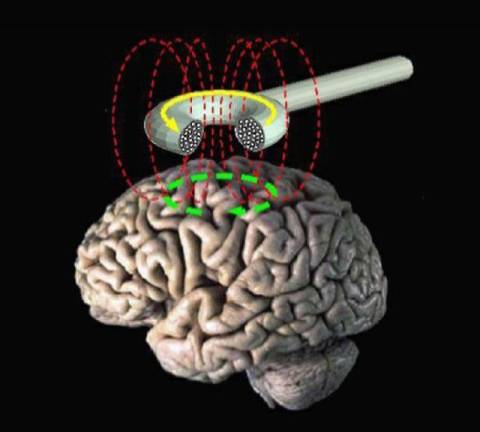 Our contributor reveals how transcranial magnetic stimulation helps quiet the OCD beast within by using magnetic fields to stimulate nerve cells in the brain to improve symptoms of major depression.